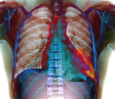Lung Infection Photograph By Du Cane Medical Imaging Ltd Pixels