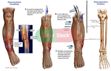 Multiple Left Leg Fractures With Surgical Fixation Doctor Stock