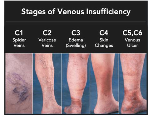 Chronic Venous Insufficiency Stages Explained