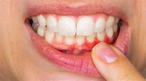 Symptoms And Treatment Of Gum Disease