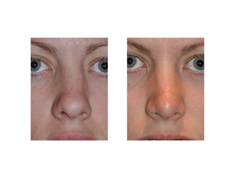 Rhinoplasty For The Crooked Nose Dr Barry Eppley Indianapolis Explore