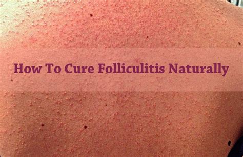 15 Natural Home Remedies For Folliculitis Cure Signs Symptoms