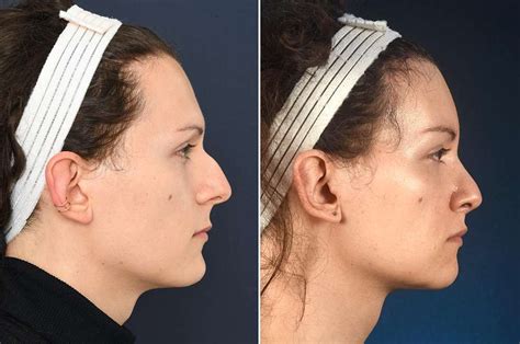 Facial Feminization Surgery Lip Lift Feminization And Rejuvenation