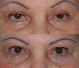 Pictures of Insurance Cover Eyelid Surgery