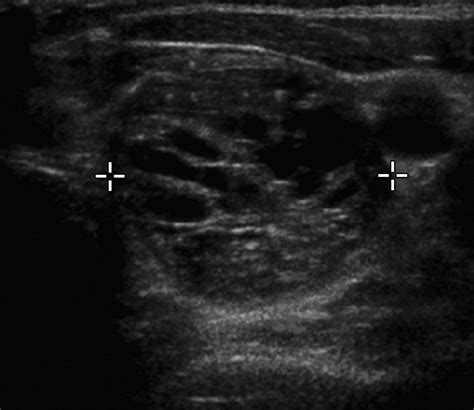 Pattern Recognition Of Benign Nodules At Ultrasound Of The Thyroid
