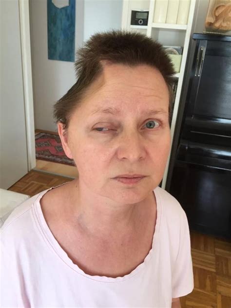 Mum Forced To Have Chunk Of Head Removed After Falling From Window