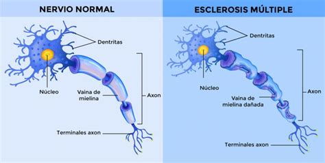≥1 1 lesión yuxtacortical iv. Esclerosis múltiple, qué es y causas