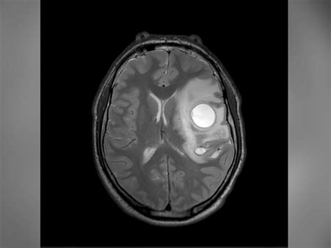 Mans Headache Caused By Tapeworm In Brain Sheds Light On Rare