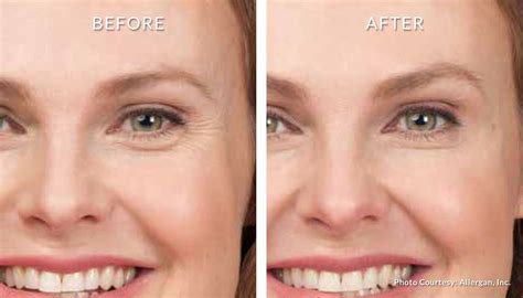 Botox For Smile Lines Before And After