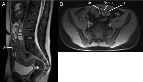 An Abdominal And Pelvic Mri Demonstrating The Urachal Remnant And Cyst Download Scientific