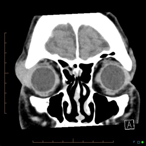 Lacrimal Gland Lymphoma Image