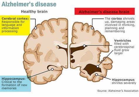 Alzheimer's infection - where does it start from