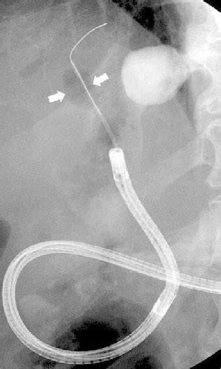 Radiograph Demonstrating Intraductal Balloon‑guided Direct Peroral