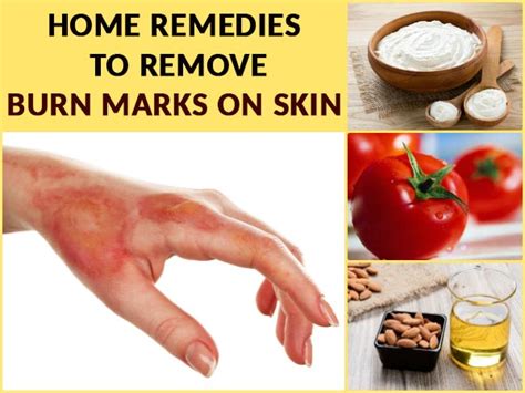 Home Remedies To Remove Burn Marks On Skin
