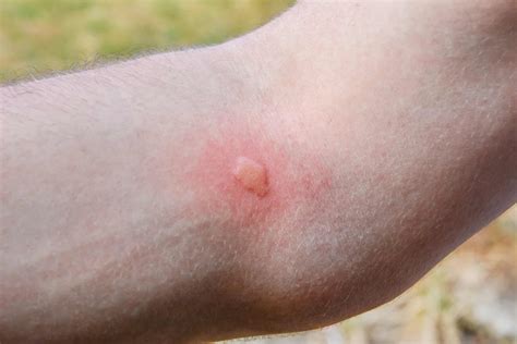 Why Do Mosquito Bites Itch Green Pest Services