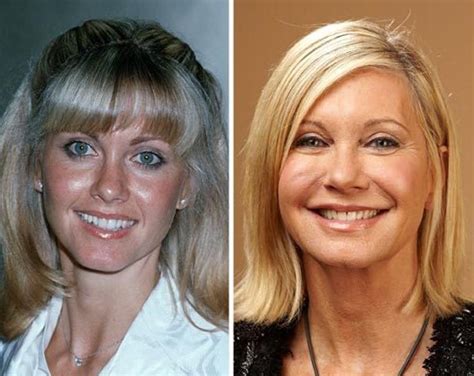 Olivia Newton John Facelift Plastic Surgery Before And After Celebie