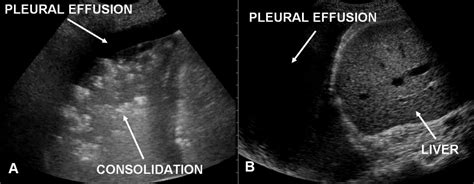 Pleural effusion is classically divided into transudate and exudate based on the light criteria. Ultrasound-Guided Thoracentesis - FOAM EM RSS