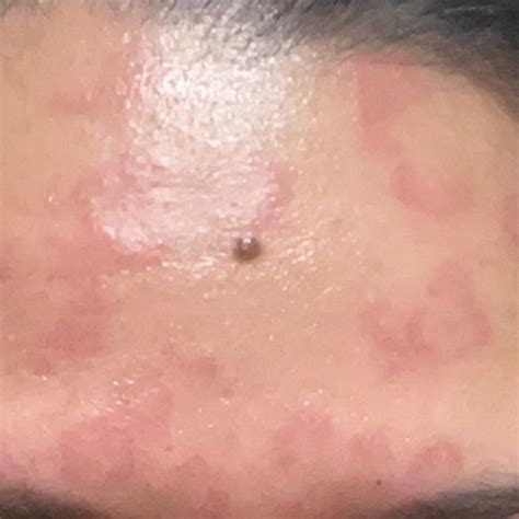 Olaplex Severe Allergic Reaction Beauty Insider Community