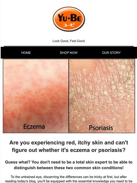 Yu Be Eczema Vs Psoriasis Whats The Difference 🤔 Milled