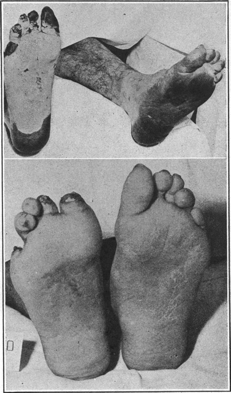 Trench Foot And Immersion Foot Nejm