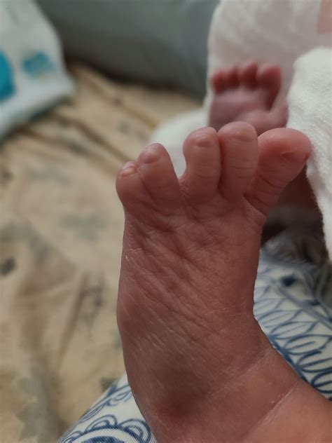 Webbed Toes BabyCenter