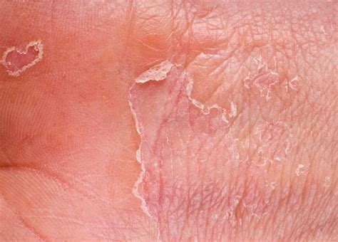 Pictures Of Eczema Slideshow