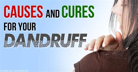 Causes And Home Remedies For Dandruff