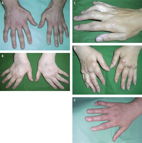 Fingers In Rheumatic Diseases Fingers Deformed Signs And Symptoms