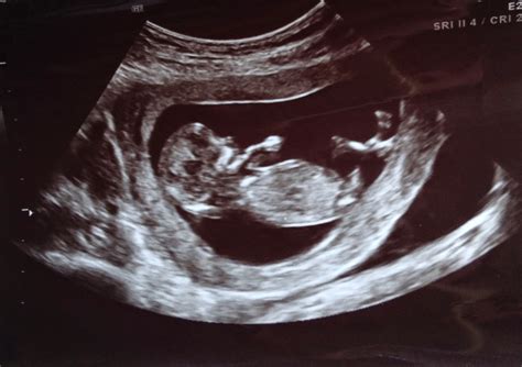 12 Week Ultrasound Gender
