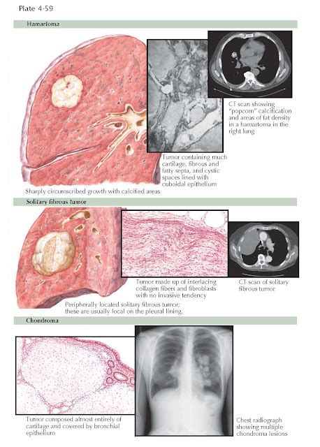 Benign Tumors Of The Lung Pediagenosis