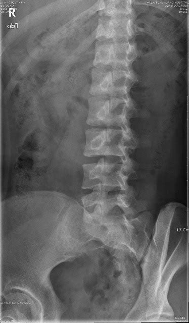 Oblique Lumbar Spine Diagram Quizlet