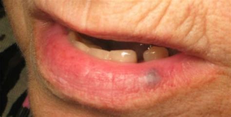 Black Spot On Bottom Lip