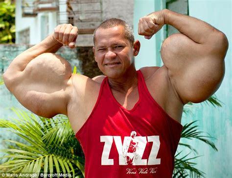 Photos Meet The Real Life “popeye” Who Injects Himself With Oil And Alcohol To Grow Monster
