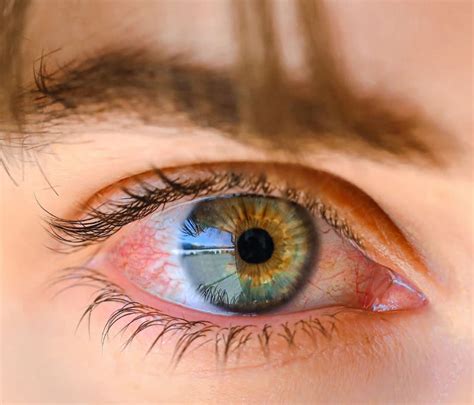 picor de ojos por síndrome del ojo seco clinicas tecnovision