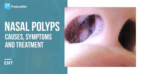 Nasal Polyps Causes Symptoms And Treatment Neet Pg Ent