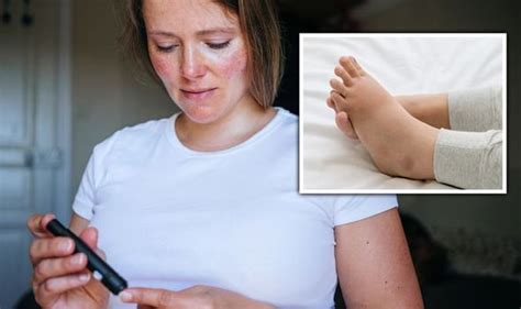 Diabetes Type 2 Symptoms Swollen Feet Could Be A Sign Of High Blood