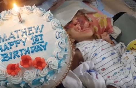 Baby Born Without Face Due To Rare Condition Defies Odds To Celebrate First Birthday World