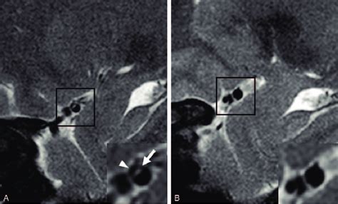 A T2 Weighted Hr Mri Shows The Intimal Flap In The Right Mca Arrow