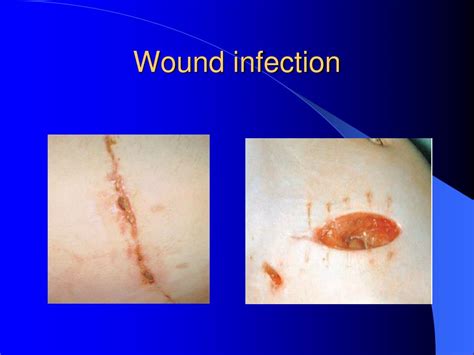 Ppt Surgical Infections Powerpoint Presentation Free Download Id