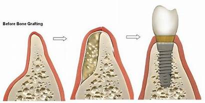 Implants Bone Dental Graft Implant Grafting Tooth