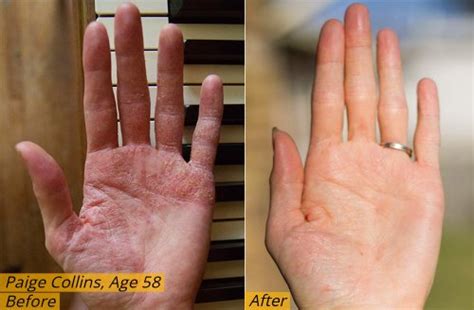 Stem Cell Therapy For Eczema