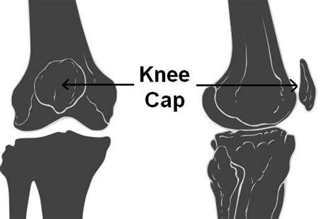 Knee Cap Pain And Types Of Kneecap Injury