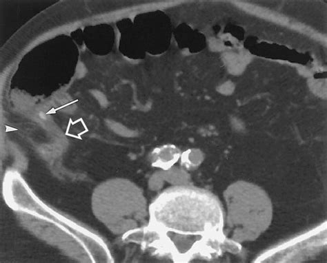 Disproportionate Fat Stranding A Helpful Ct Sign In Patients With