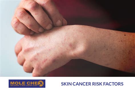Skin Cancer Risk Factors Know Your Vulnerabilities Molechex Skin