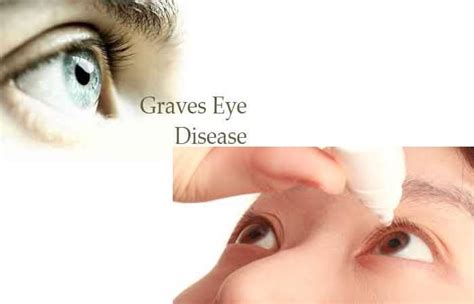 What Is Graves Disease Definition Symptoms Causes And More