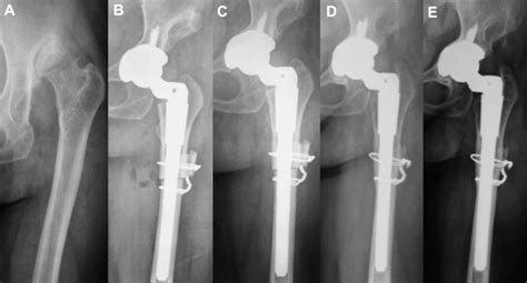 Long Term Results Of Cementless Total Hip Arthroplasty With
