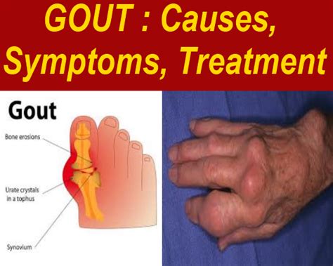 1 Of Th Best Of Gout Causes Symptoms Treatment