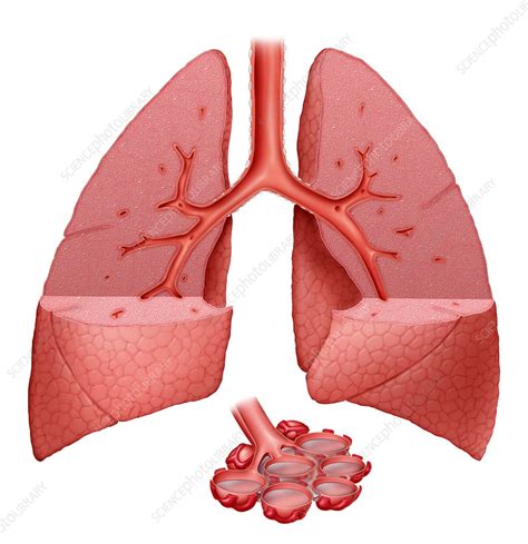 For large pleural effusions, or for those with an unknown cause, the fluid will need to be drained through a procedure called thoracentesis. Lungs With Fluid - Stock Image - C001/4977 - Science Photo ...