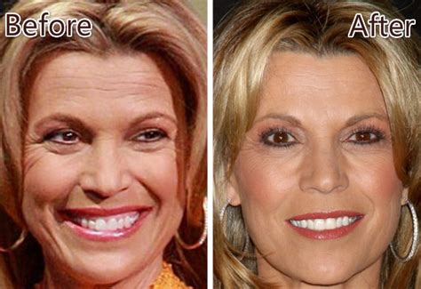 Vanna White Plastic Surgery Before And After Botox And Nose Job Star My Xxx Hot Girl