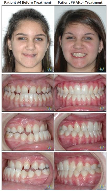 Braces Before And Afters Walton Orthodontics